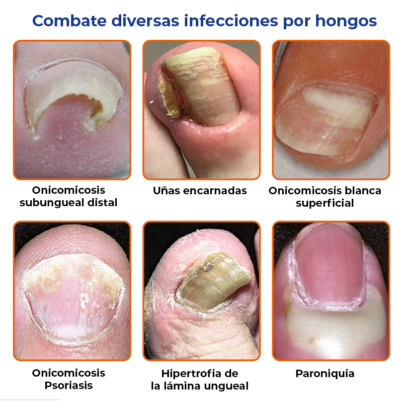 [2X1] |ELIMINA LOS HONGOS DE LAS UÑAS EN 5 DÍAS Y EVITA QUE APAREZCAN PARA SIEMPRE